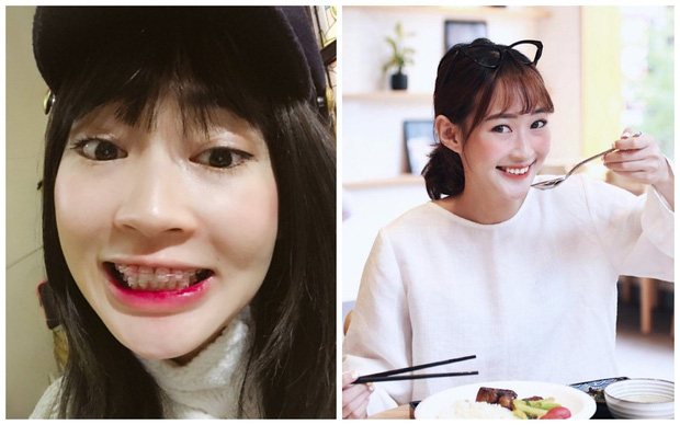 Niềng răng xong đẹp như thế nào? Các ca niềng răng hô của sao 4