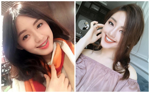 Niềng răng xong đẹp như thế nào? Các ca niềng răng hô của sao 1