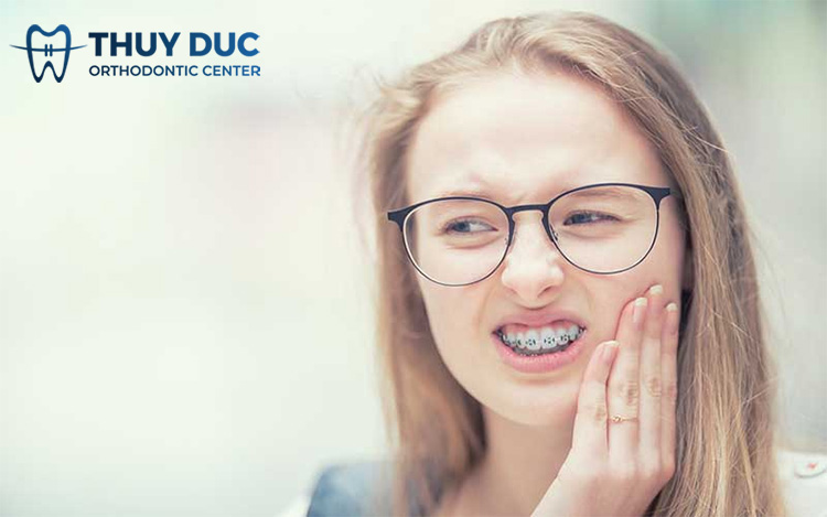 Nhược điểm của niềng răng bằng mắc cài kim loại tự buộc 1 Nhược điểm của niềng răng bằng mắc cài kim loại tự buộc 1