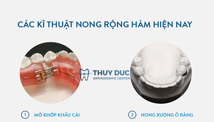 Các kỹ thuật nong hàm phổ biến hiện nay 1 Các kỹ thuật nong hàm phổ biến hiện nay 1