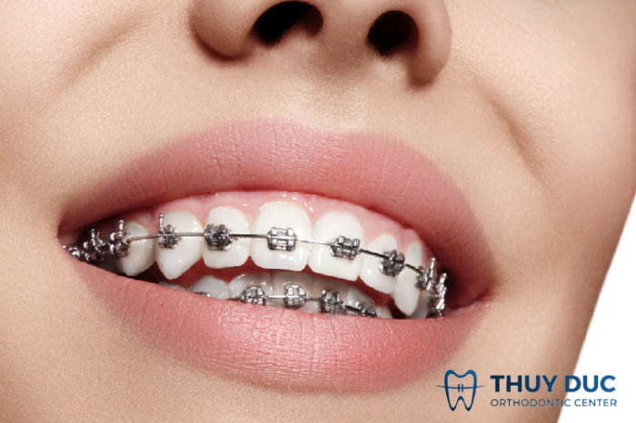 Phương pháp niềng răng mắc cài 1