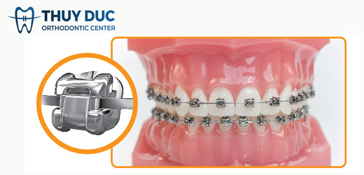 Ưu điểm của mắc cài kim loại tự buộc 1 Ưu điểm của mắc cài kim loại tự buộc 1