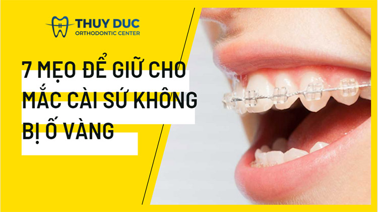 7 mẹo bạn nên biết để giữ cho mắc cài sứ không bị vàng 1