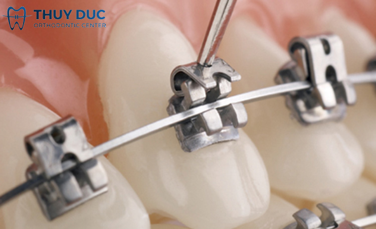 Công việc phải giao tiếp nhiều, có nên niềng răng không? 1