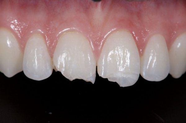 Có nên mài răng cửa để khắc phục tình trạng hô, vẩu hay không? 1