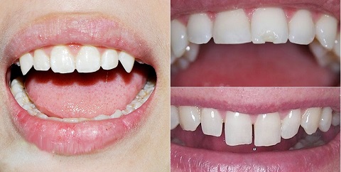 1. Răng cửa bị hô 1 1. Răng cửa bị hô 1