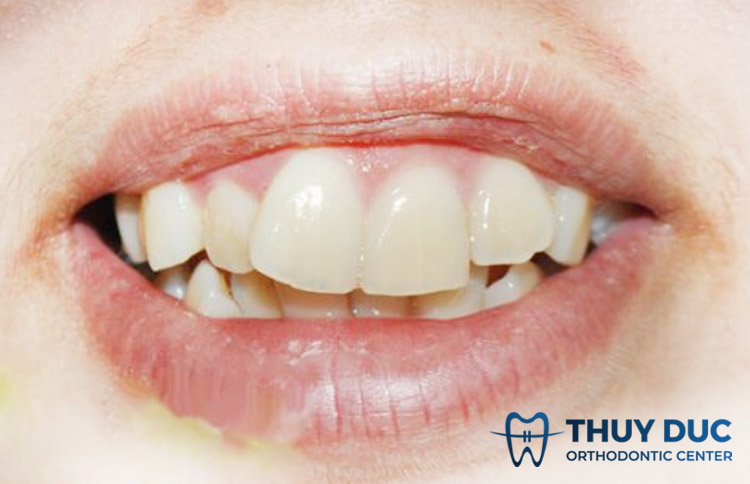 Không xác định đúng tình trạng răng hô ban đầu 1 Không xác định đúng tình trạng răng hô ban đầu 1