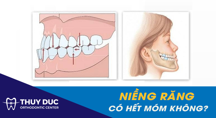 Niềng răng có hết móm không? Khi nào răng móm nên niềng? 1 Niềng răng có hết móm không? Khi nào răng móm nên niềng? 1