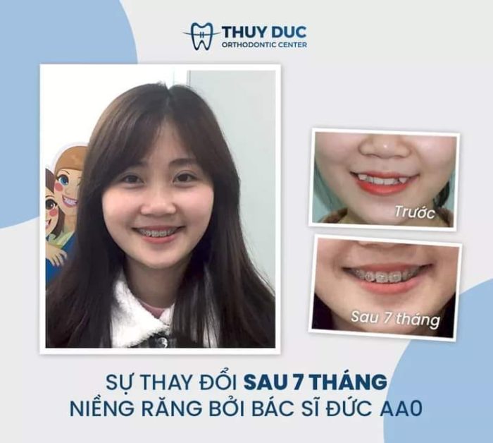 Chi phí và kết quả khi niềng răng hô nhẹ