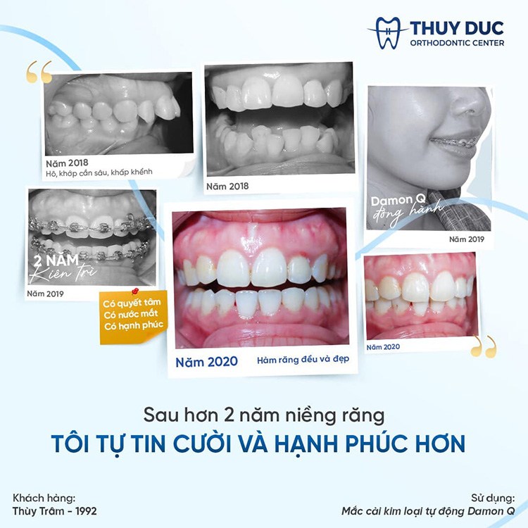 Chỉnh răng hô vẩu bằng phương pháp niềng răng mắc cài kim loại 1