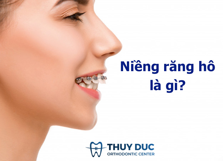 Niềng răng hô là gì? Phương pháp nào niềng răng hô hiệu quả nhất 1 Niềng răng hô là gì? Phương pháp nào niềng răng hô hiệu quả nhất 1