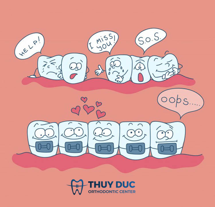 Phụ thuộc vào phương pháp niềng răng 1 Phụ thuộc vào phương pháp niềng răng 1