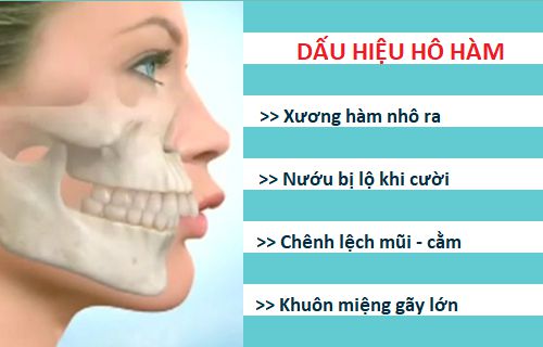 Niềng răng có hết hô không? 1 Niềng răng có hết hô không? 1