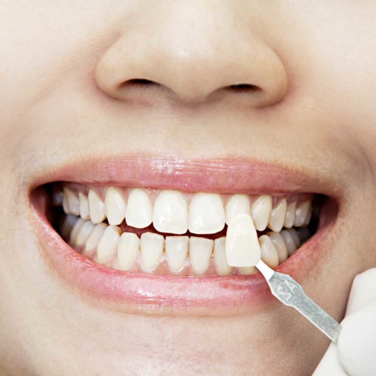 Chữa răng hô tại Nha khoa 1