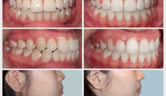 Phương pháp nào chỉnh răng hô hiệu quả nhất?