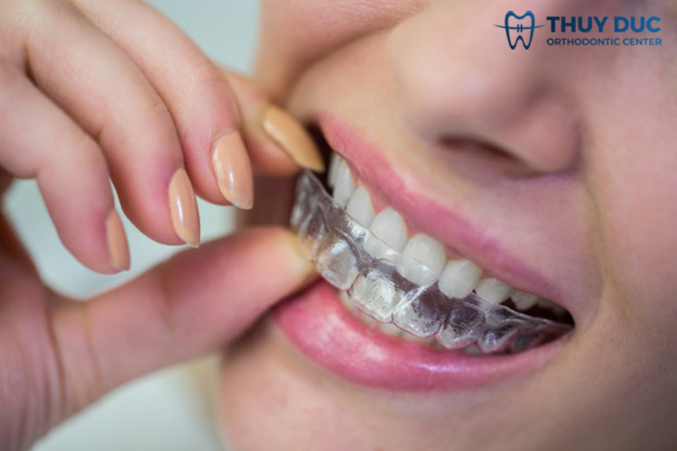 Niềng răng trong suốt Invisalign 1 Niềng răng trong suốt Invisalign 1