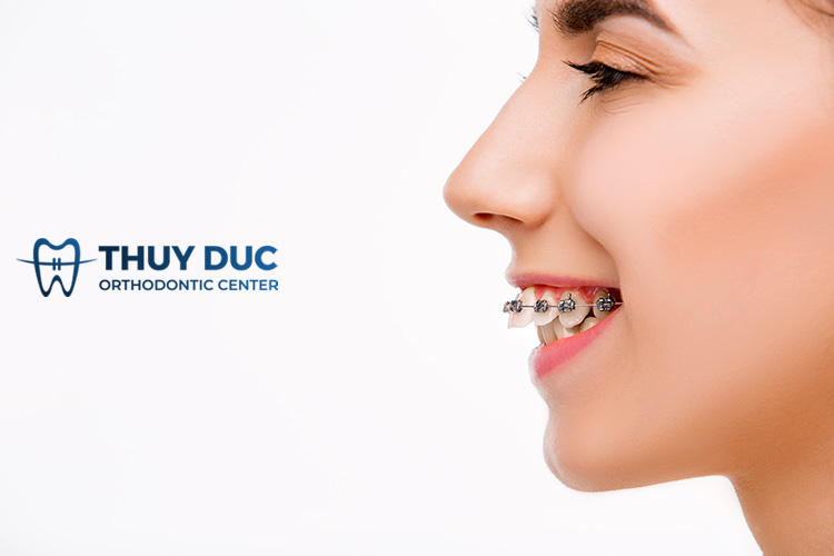 Niềng răng mắc cài kim loại thường 1 Niềng răng mắc cài kim loại thường 1