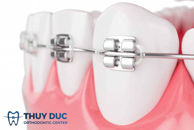 Niềng răng mắc cài kim loại tự buộc 1 Niềng răng mắc cài kim loại tự buộc 1
