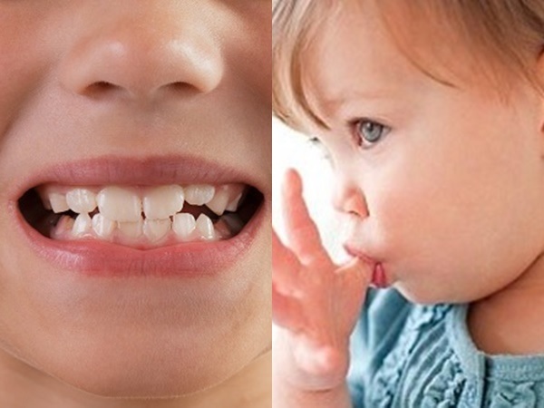 Nguyên nhân do răng 1