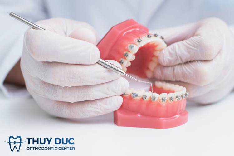 Niềng răng xong bị hô làm sao để khắc phục? 1 Niềng răng xong bị hô làm sao để khắc phục? 1