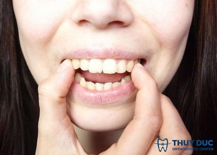 Niềng răng xong bị móm 1