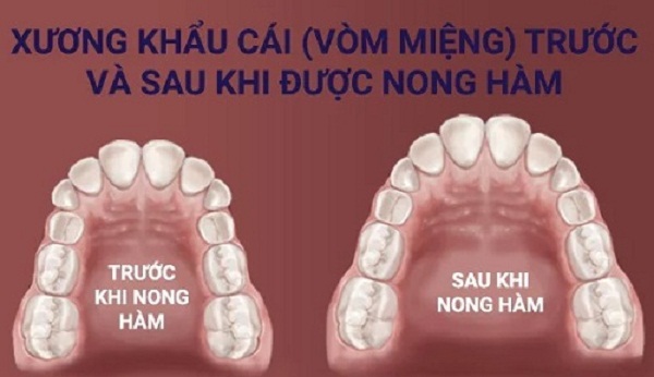 Nong hàm có thay đổi khuôn mặt không? 1 Nong hàm có thay đổi khuôn mặt không? 1