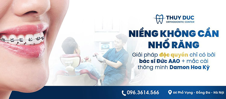 Phương pháp niềng răng mới nhất tại Nha khoa Thúy Đức 1