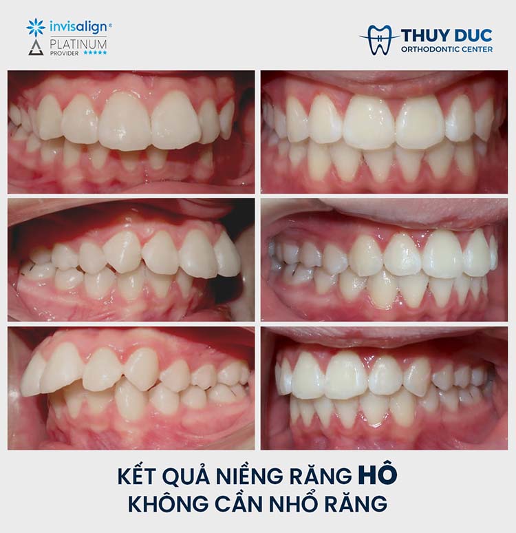 Quy trình niềng răng hô tại Nha khoa Thúy Đức 1 Quy trình niềng răng hô tại Nha khoa Thúy Đức 1