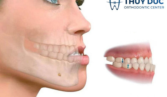 tieu xuong ham do nieng rang