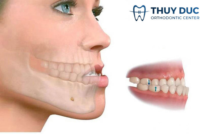 Răng hàm dưới đưa ra có ảnh hưởng gì đến chức năng ăn nhai và ngoại hình?