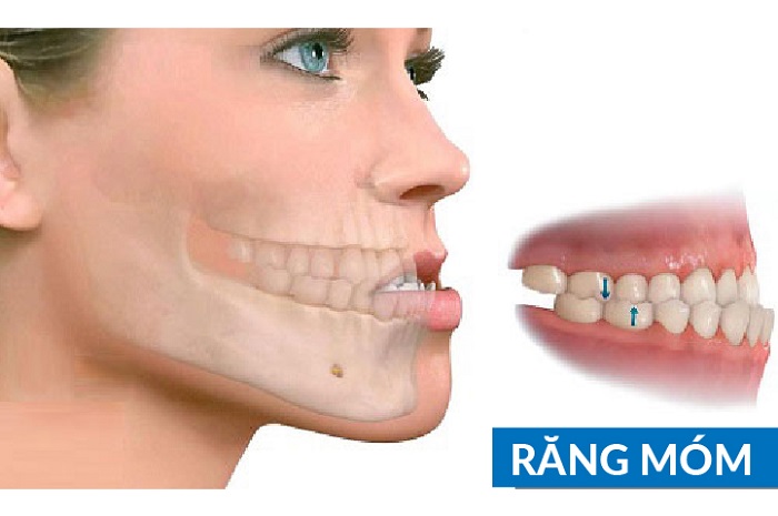 Cách nhận biết răng bị hô hàm dưới 1 Cách nhận biết răng bị hô hàm dưới 1