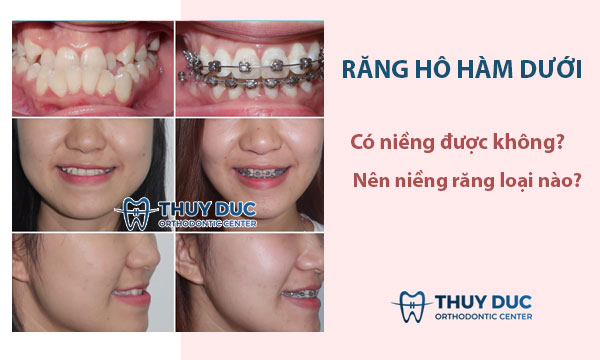 Can răng hô hàm dưới recur after treatment?
