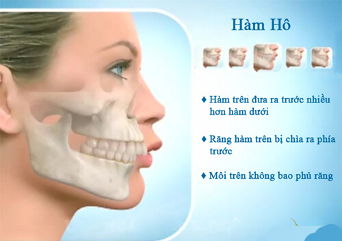Thế nào là răng hô? 1