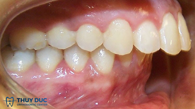 Các dạng răng hô nặng thường gặp 1 Các dạng răng hô nặng thường gặp 1