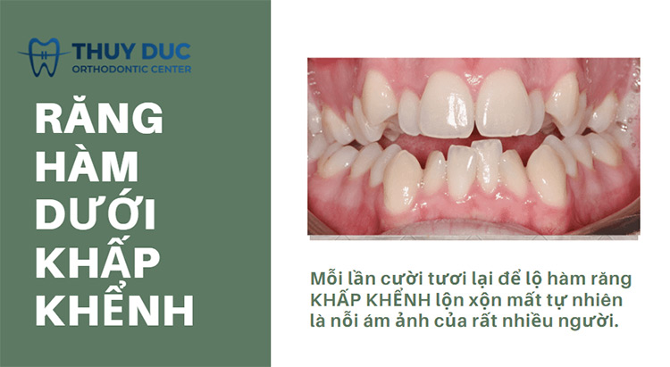 Răng hàm dưới khấp khểnh phải làm sao? Niềng có hiệu quả không? 1
