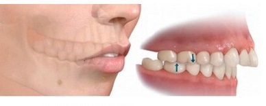 Sai khớp cắn loại 2 (khớp cắn hô hay vẩu - Protruded teeth) 1 Sai khớp cắn loại 2 (khớp cắn hô hay vẩu - Protruded teeth) 1