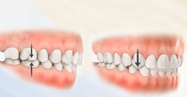 Sai khớp cắn đối đầu (edge-to-edge bite) 1 Sai khớp cắn đối đầu (edge-to-edge bite) 1