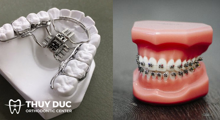 Ưu điểm của chỉnh nha tháo lắp có ốc nong so với chỉnh nha tháo lắp không có ốc nong 1 Ưu điểm của chỉnh nha tháo lắp có ốc nong so với chỉnh nha tháo lắp không có ốc nong 1
