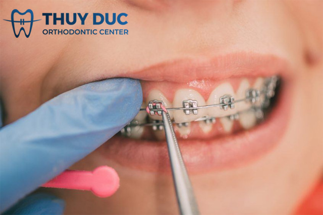 Cần sử dụng dây thun khi niềng răng trong những trường hợp nào? 1