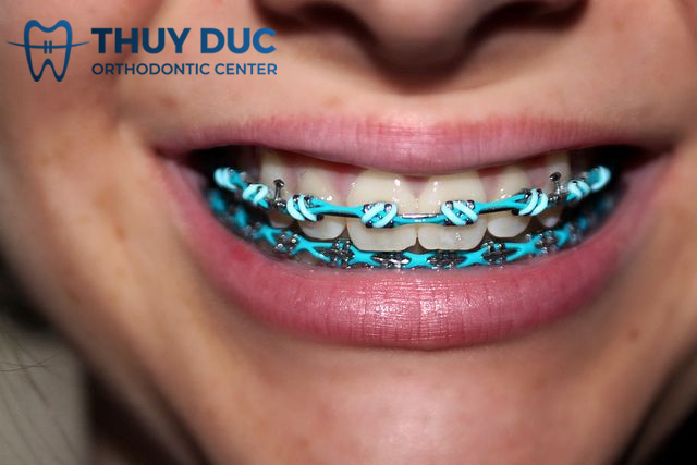 Những tác dụng của dây thun niềng răng 1