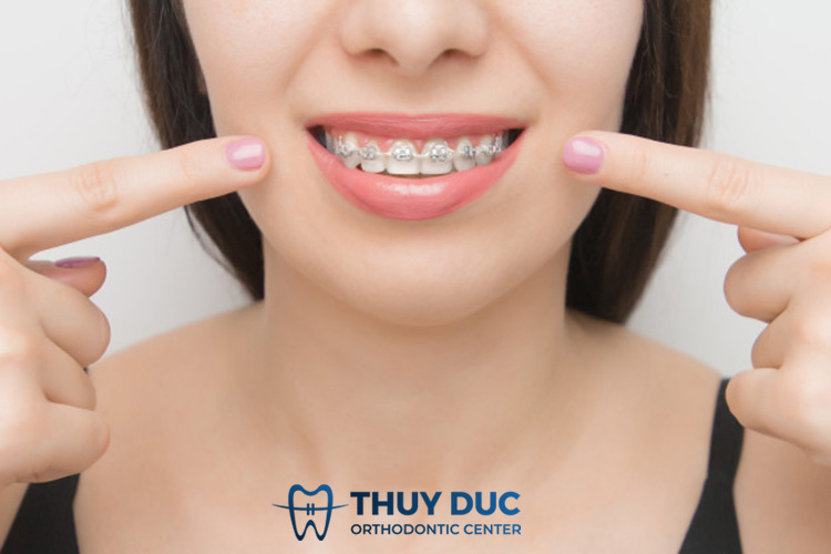 Niềng răng mất thời gian bao lâu? 1 Niềng răng mất thời gian bao lâu? 1