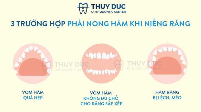 Trường hợp nào phải nong hàm khi niềng răng? 1 Trường hợp nào phải nong hàm khi niềng răng? 1