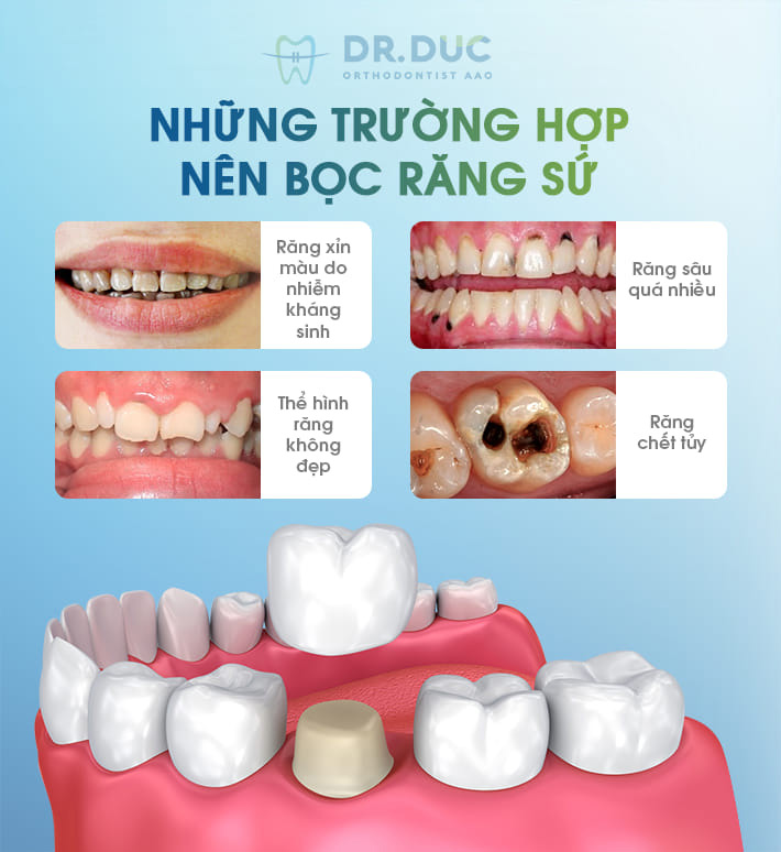 Bọc răng sứ 1 Bọc răng sứ 1