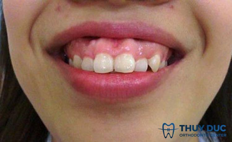 Trường hợp nào có thể làm cho răng đều hơn mà không cần niềng? 1 Trường hợp nào có thể làm cho răng đều hơn mà không cần niềng? 1