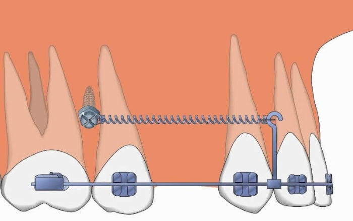 Cắm vít niềng răng (Minivis) là gì? Có đau không? 1 Cắm vít niềng răng (Minivis) là gì? Có đau không? 1