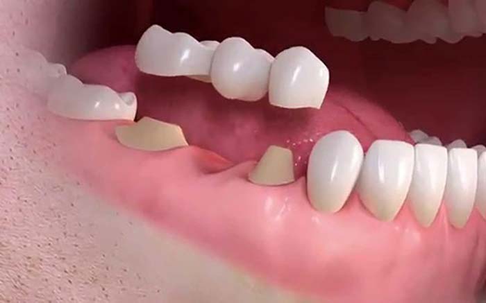 Cầu răng sứ 1 Cầu răng sứ 1