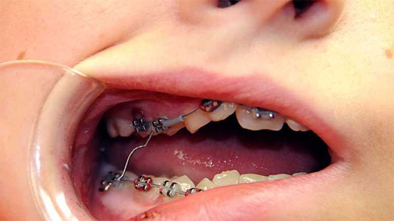 Chảy máu chân răng khi niềng răng phải làm sao? 1