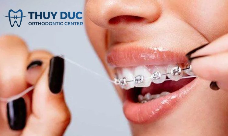 Niềng răng là gì? 1
