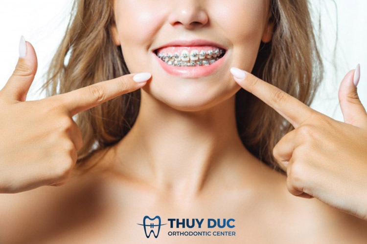 Chi phí niềng răng hô vẩu hàm trên là bao nhiêu? 1 Chi phí niềng răng hô vẩu hàm trên là bao nhiêu? 1
