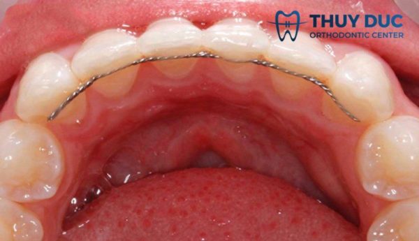 Hàm duy trì tháo lắp là gì? 1